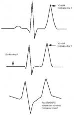 Obr. 1 - Typické změny na EKG při hyperkalémii