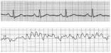 Obr. 2 - Normální EKG křivka a níže EKG obraz komorové arytmie při hyperkalémii