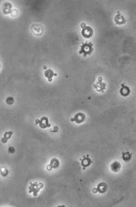 Obr. 2 - Typicky tvarově změněné (dysmorfní) erytrocyty při vyšetření močového sedimentu mikroskopem s fázovým kontrastem