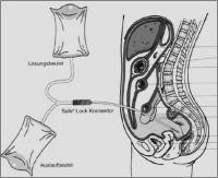 Princip peritoneální dialýzy